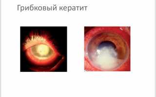 Даже отдыхать в саду может быть опасно! Насколько страшен грибковый кератит и как он лечится?