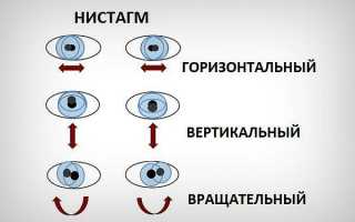Как совладать с глазами? Вертикальный нистагм: что это такое, причины развития, лечение