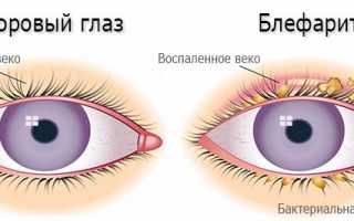 Как избавиться от блефарита в кратчайшие сроки? Преимущества комплексного лечения