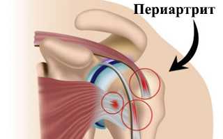 Симптоматика периартрита суставов: виды, частые проявления