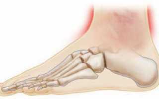 Воспаление голеностопного сустава: причины, симптоматика, лечение
