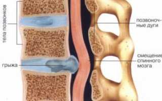 Грыжа позвоночника: причины, симптомы, диагностика, лечение