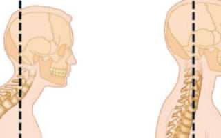 Кифоз шейного отдела позвоночника: причины, лечение, профилактика