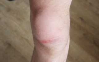 Дегенеративные изменения менисков коленного сустава: патологии