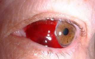Немедленная помощь сохранит зрение! Если появилась кровь в глазу после удара: что делать?