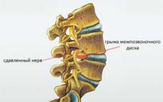 Грыжа поясничного отдела позвоночника: симптомы и лечение