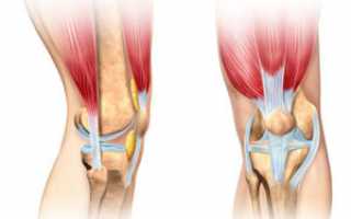 Тендиноз – информация о патологии, причины, симптомы, лечение
