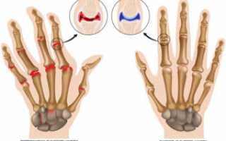 Боль в суставах рук: лекарства, физиотерапия, народное лечение