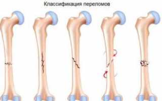 Перелом бедра – как проявляется? Симптомы, диагностика, лечение