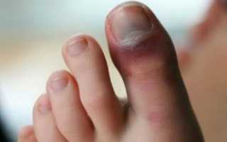 Ушиб пальца на ноге: причины, симптоматика, лечение