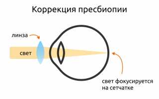 Возможно ли предотвращение развития возрастной дальнозоркости? Методы лечения пресбиопии