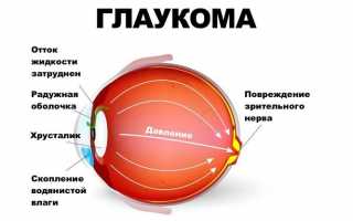 Незаметная поначалу и этим опасная: что важно знать о глаукоме