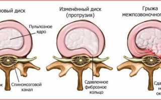 Симптоматика и лечение синдрома люмбалгии