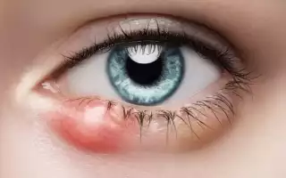 То, что портит внешний вид — ячмень под глазом. Как эффективно его лечить?