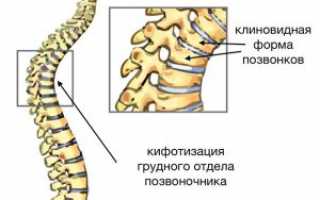 Кифоз грудного отдела позвоночника: симптомы, диагностика и лечение