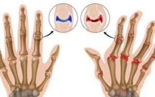 Отложение солей в суставах: что это такое? Причины, лечение