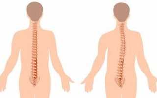 Сколиоз 3 степени: особенности, причины, лечение, профилактика