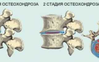 Остеохондроз 2 степени: причины, симптоматика, диагностика, лечение