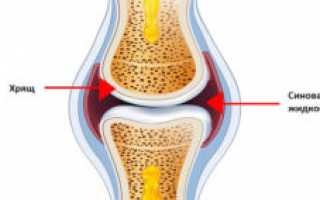 Синовит коленного сустава: как распознать и вылечить недуг?