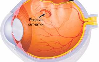 Игнорирование проблемы может привести к слепоте! Симптомы отслоения сетчатки глаза