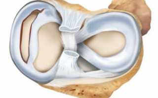 Разрыв мениска: как происходит? Cимптомы, диагностика и лечение