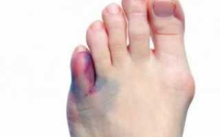 Ушиб мизинца на ноге: характеристика, симптомы, лечение