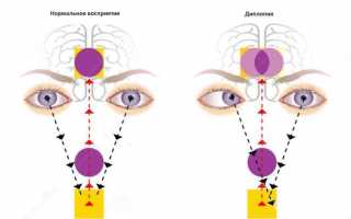 Как обезопасить себя от диплопии: монокулярная и другие формы болезни