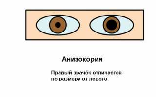 Когда зрачок не реагирует на свет: почему возникает анизокория у ребенка и опасно ли это?