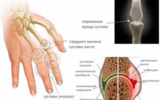 Ювенильный ревматоидный артрит – частые симптомы и лечение