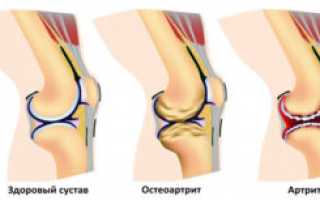 Остеоартрит: классификации, причины, симптомы, лечение