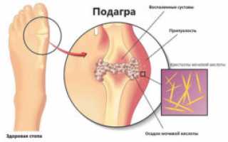 Подагра: болезнь изобилия, симптоматика, причины и лечение