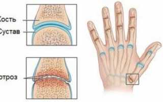 Артроз большого пальца руки: причины, симптоматика, лечение