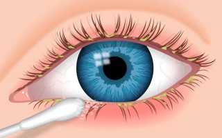 Как одолеть заболевание в короткие сроки? Чем лучше всего лечить воспаление века глаза