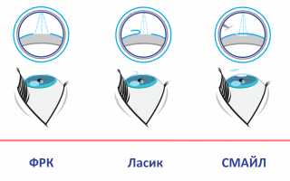 Восстановит зрение раз и навсегда — лазерная коррекция ЛАСИК
