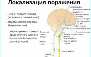 Признаки и лечение синдрома Горнера