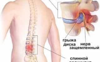 Радикулит – симптомы, причины, диагностика, лечение и профилактика