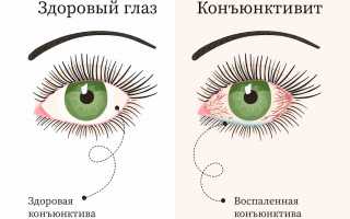 Защитимся от конъюнктивита! Как передаётся вредоносная инфекция?