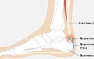 Ахиллобурсит – что за болезнь? Причины, симптомы и лечение