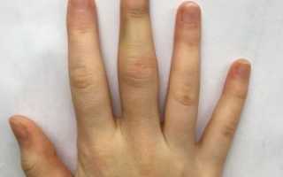 Перелом пальца на руке: причины, лечение, реабилитация
