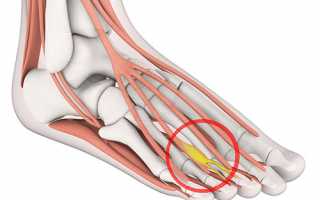 Неврома Мортона – что это такое? Причины, симптоматика, лечение