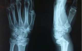 Перелом лучевой кости руки: симптомы, лечение, реабилитация