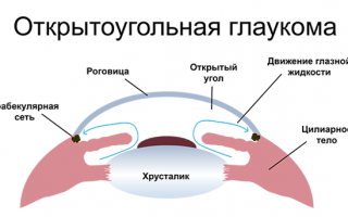 Коварная болезнь! Что необычного в открытоугольной глаукоме?