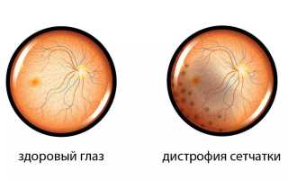 Главное, что нужно знать об этой болезни! Дистрофия сетчатки глаза: что это такое, симптомы