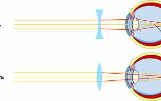 Здесь вижу — а тут не вижу: отличия близорукости и дальнозоркости