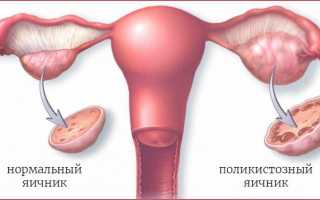 Проявления синдрома поликистозных яичников и эффективные способы лечения