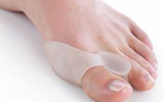 Артроз большого пальца ноги: причины, диагностика и терапия