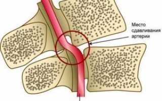 Синдром позвоночной артерии при шейном остеохондрозе: особенности, лечение