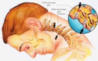 Шейный остеохондроз: причины, виды, симптомы и методы лечения