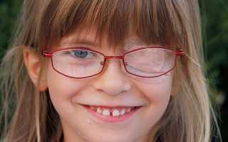 Синдром «ленивого глаза» у детей: можно ли заставить нерадивый орган зрения вновь трудиться?