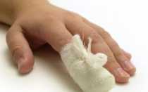 Ушиб пальца на руке: первая помощь, симптоматика, лечение